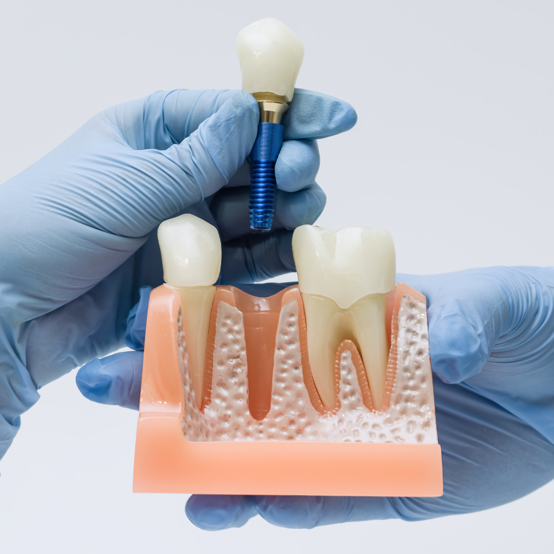 Dental Implants in Andheri East